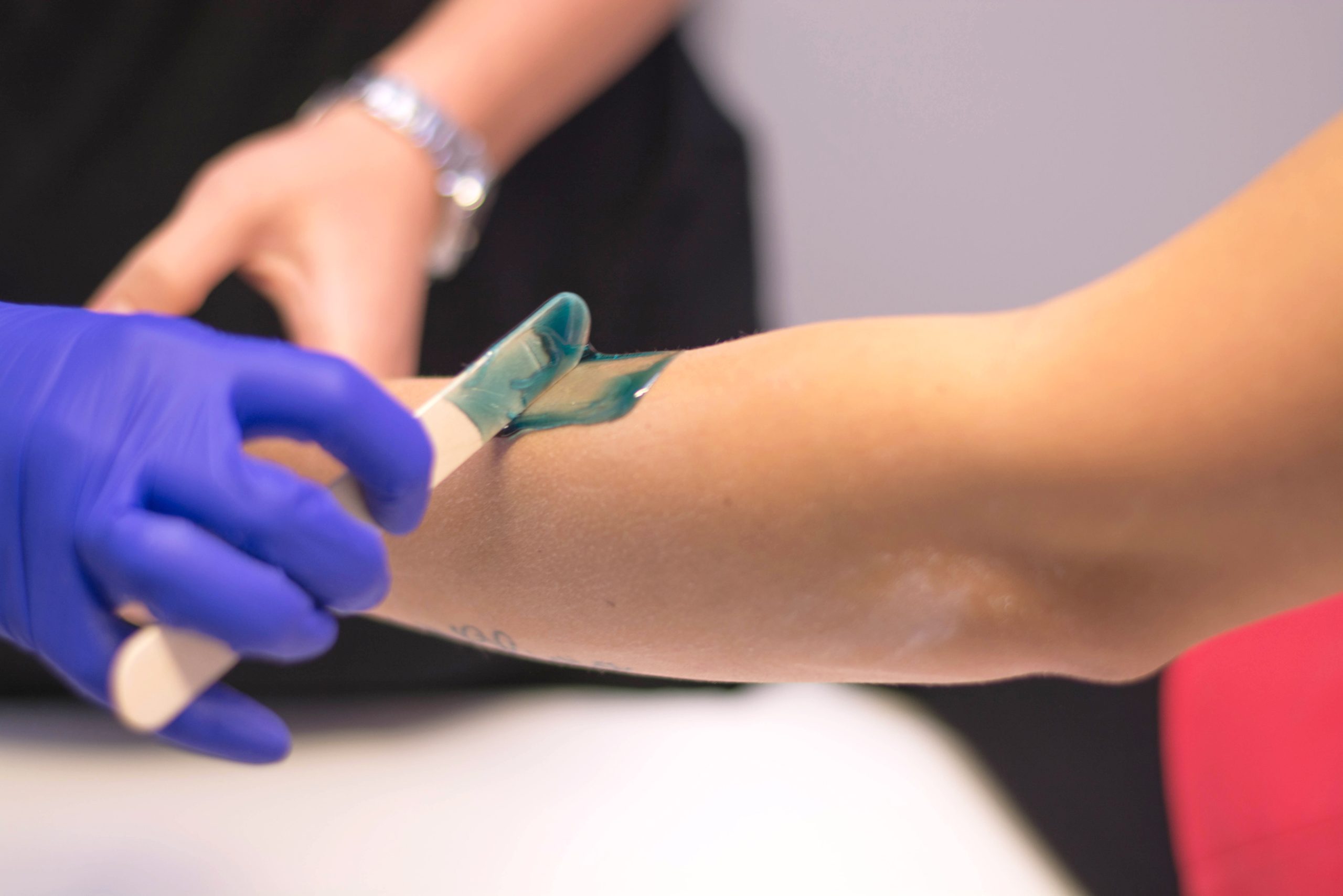 What do dark underarm spots mean? Depilation and hyperpigmentation