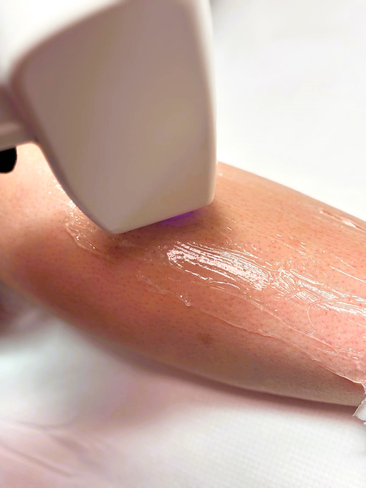 How to Choose the Right Specialist for Laser Hair Removal? 5 Things to Consider