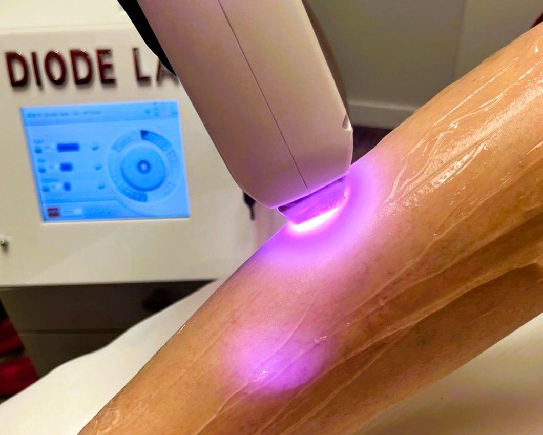 Why can’t everyone undergo laser hair removal? On differences in skin and hair types